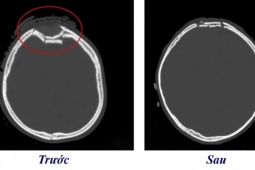 Sức khỏe đời sống - Bé 3 tuổi bị chấn thương sọ não vì sai lầm rất nhiều cha mẹ vẫn mắc khi cho con ngồi xe máy