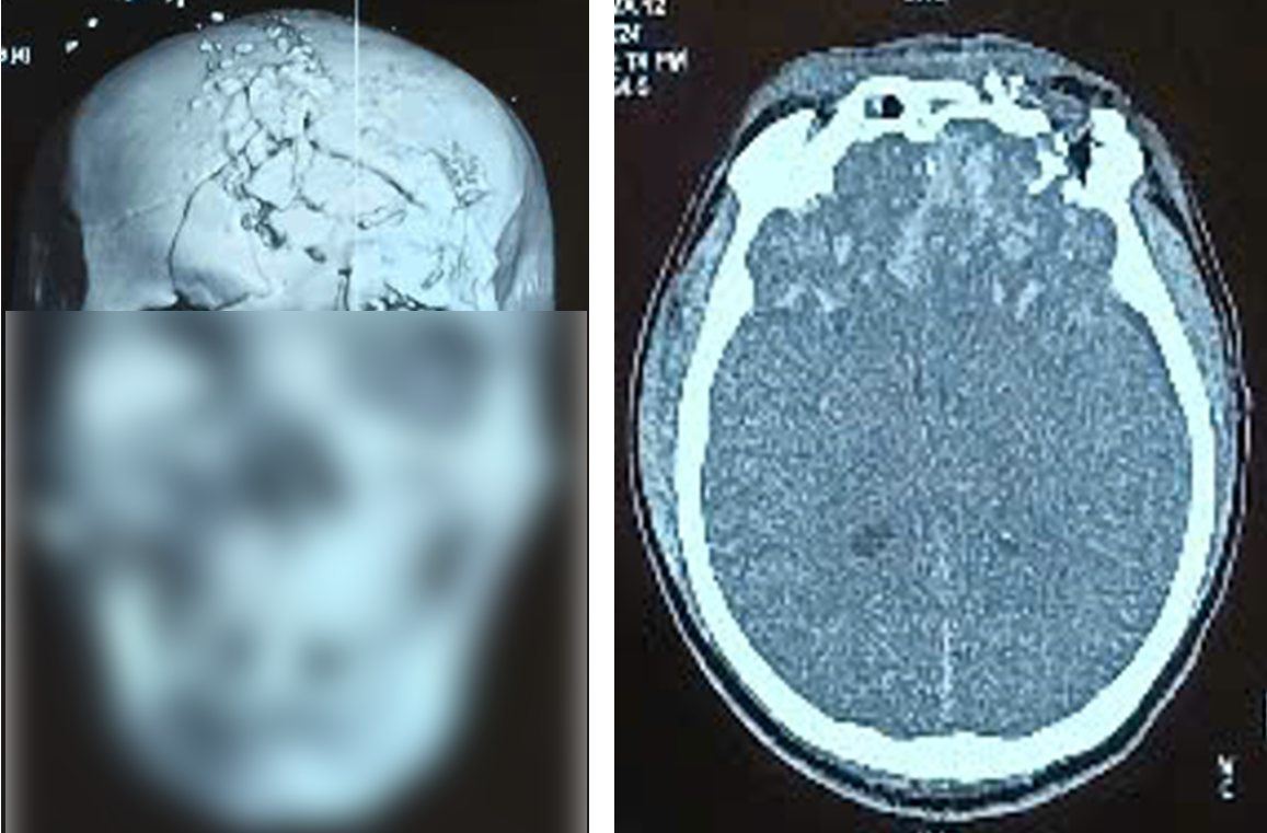 Hình ảnh phim Cắt lớp vi tính xương sọ và tổn thương não khi bệnh nhân nhập viện.