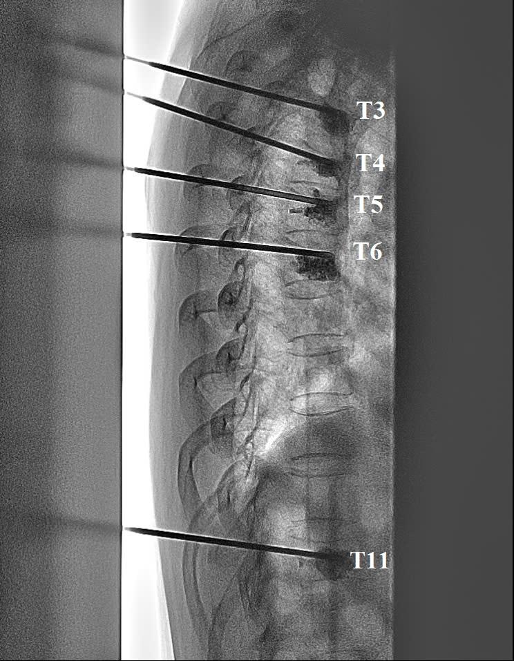 Đưa kim và bơm xi măng khôi phục 5 đốt sống lún xẹp cho bệnh nhân