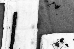 Sức khỏe đời sống - Hi hữu: Bé gái 3 tuổi mang cành cây dài 16 cm trong bụng suốt 4 tháng