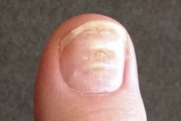 Sức khỏe đời sống - 7 bất thường ở móng tay cảnh báo bệnh nguy hiểm