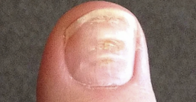 7 bất thường ở móng tay cảnh báo bệnh nguy hiểm