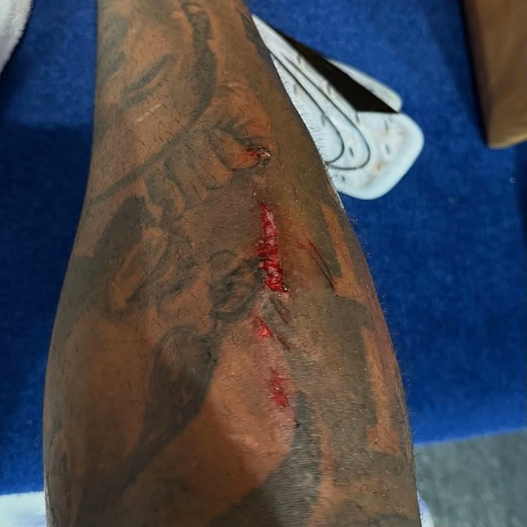 Reece James chia sẻ hình ảnh vết rách trên chân sau chiến thắng của Chelsea trước Liverpool