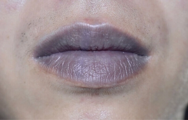 3 dấu hiệu trên mặt cho thấy phổi đang bị “tàn phá”, đừng chủ quan kẻo “tử thần gõ cửa”! - 2