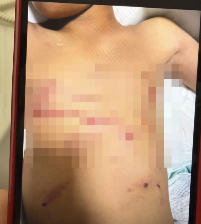 Cơ thể bé trai với nhiều vết cào cắn. Ảnh: Viralpress