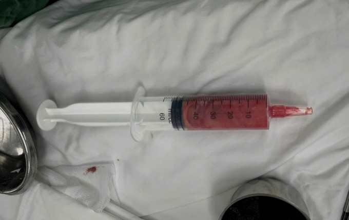 Dịch mủ được hút ra từ mô vú trong ca phẫu thuật. Ảnh: Bệnh viện cung cấp