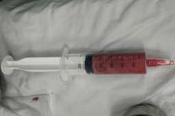 Cô gái suýt hỏng vòng một vì tiêm filler trôi nổi