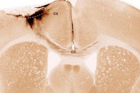 Tìm ra phương pháp mới hứa hẹn “đảo ngược” đột quỵ