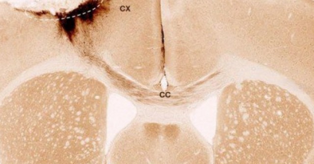 Tìm ra phương pháp mới hứa hẹn “đảo ngược” đột quỵ