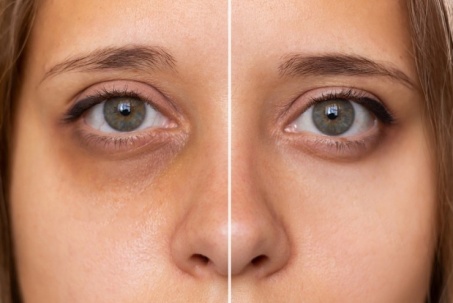 Nhiều người bị quầng thâm mắt mà không biết đây có thể là dấu hiệu của...