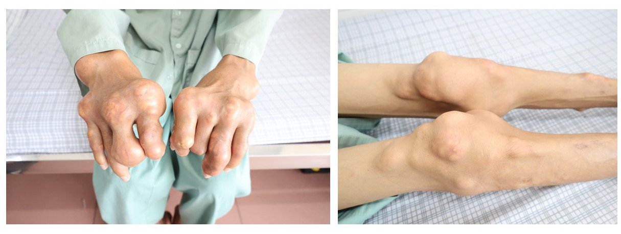 Bệnh nhân bị nổi hạt tứ chi vì tự ý điều trị gout. 