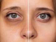 Nhiều người bị quầng thâm mắt mà không biết đây có thể là dấu hiệu của nhiều bệnh nguy hiểm