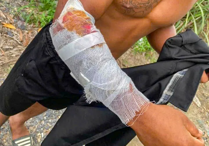 Một người dân bị cá sấu tấn công bị thương. Ảnh: AB