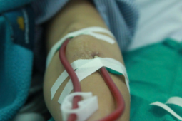 Sức khỏe đời sống - Suy thận ở tuổi 29, người phụ nữ tiếc nuối vì bỏ qua 1 dấu hiệu cảnh báo ở chân