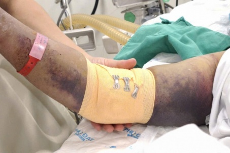 Nhiều người nguy kịch vì sốt xuất huyết