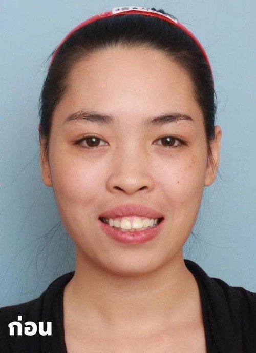 Vũ Thanh Quỳnh được biết đến rộng rãi vào năm 2014 khi tham gia chương trình thực tế 'Change Life - Thay đổi cuộc sống'. Trước phẫu thuật thẩm mỹ, cô sở hữu gương mặt kém sắc với khuyết điểm lớn là hàm hô, gương mặt thô, và ánh nhìn thiếu tự tin, khiến cô gặp nhiều rào cản trong cuộc sống và công việc.