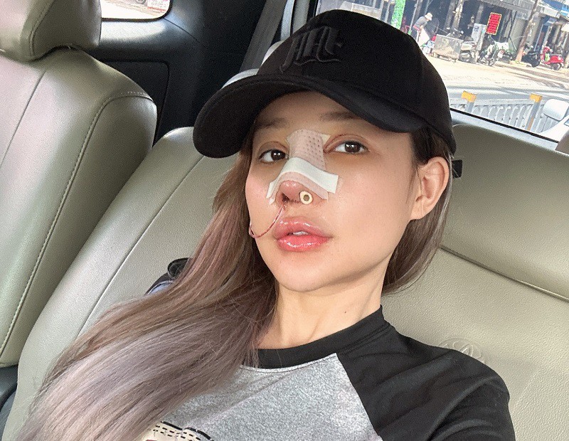 Ngân 98 đã sửa mũi tới 11 lần.