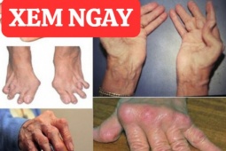 Tin tức sức khỏe - Giật mình: 6 thói quen tưởng vô hại nhưng lại tàn phá xương khớp cực nhanh