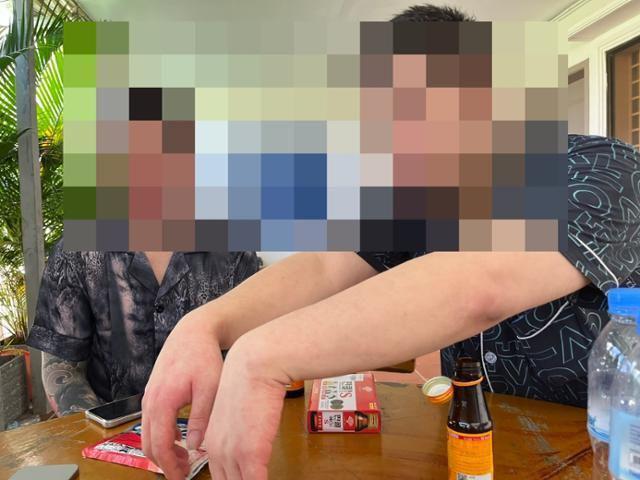 Một nạn nhân người Hàn Quốc cho xem những vết sẹo trên cánh tay – dấu tích của chuỗi ngày bị tra tấn và ép buộc làm việc trong đường dây lừa đảo tại Campuchia. Ảnh: The Korea Times