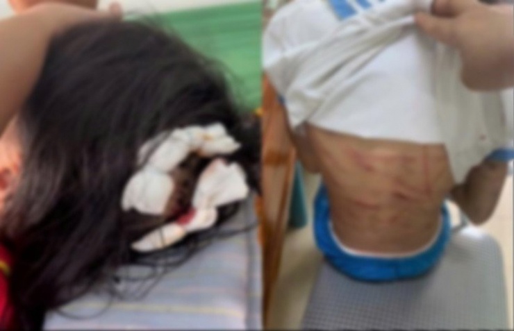 Nữ sinh lớp 5 chi chít vết thương trên người nghi bị cha dượng bạo hành.