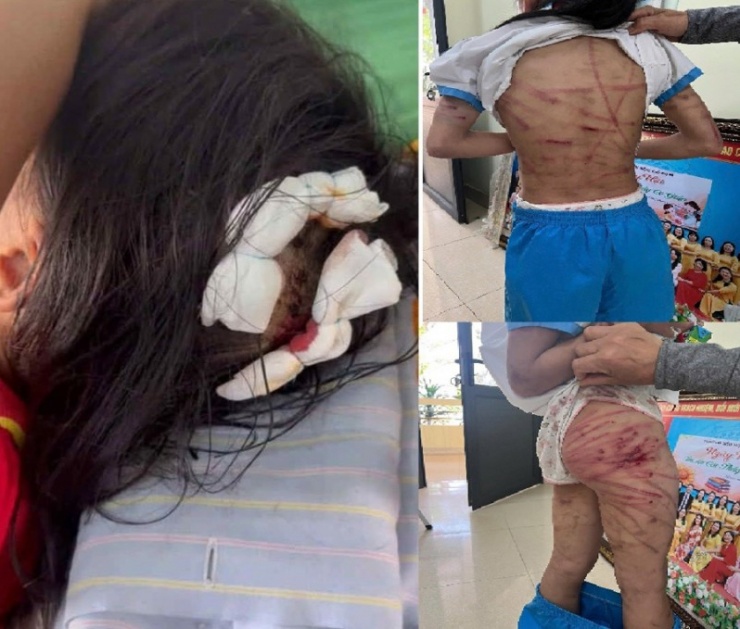 Hình ảnh cháu bé bị cha dượng bạo hành dã man.