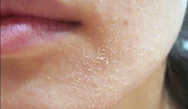 Da dễ khô khi vào thu, cần dưỡng ẩm sâu (Hình ảnh minh họa)