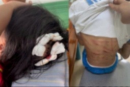 Tin tức trong ngày - Bé gái nghi bị bố dượng bạo hành ở Hà Tĩnh phải khâu 7 mũi, có 3 vết thương ở đầu