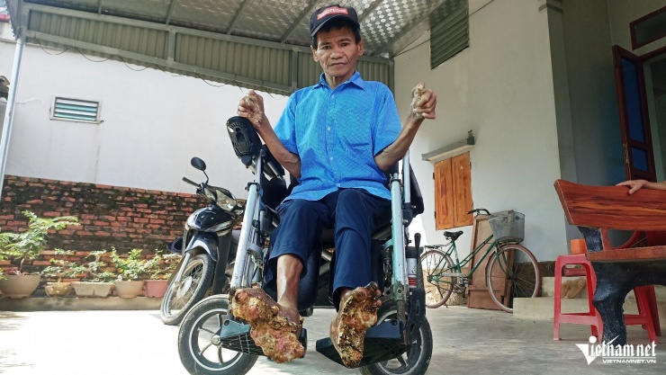 Cuộc sống hiện tại của ông Sơn chỉ gắn liền với chiếc xe lăn để di chuyển