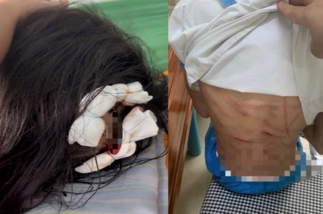 Các vết thương trên người bé L sau khi bị cha dượng bạo hành. Ảnh: CTV