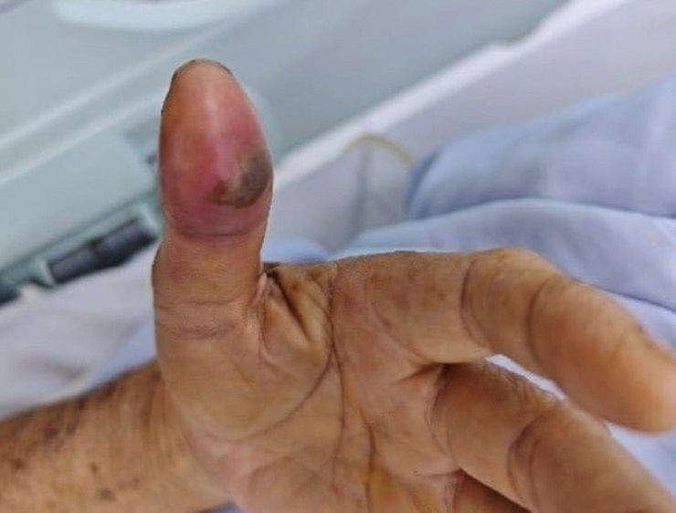 Vết rắn cắn trên ngón tay cái khiến bệnh nhân bị nhiễm độc nặng