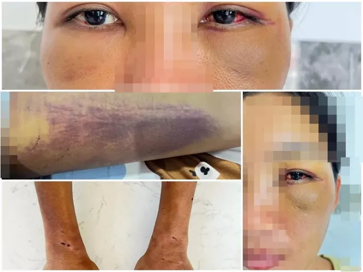 Ngoài bị giữ trái pháp luật, nạn nhân D còn bị hành hung với thương tích trầm trọng.