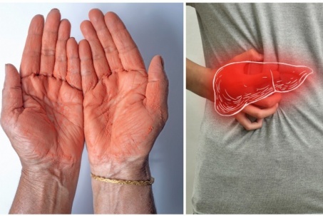 Những dấu hiệu ở tay cảnh báo gan đang "kêu cứu"