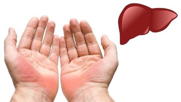 Những dấu hiệu ở tay cảnh báo gan đang "kêu cứu" - 1