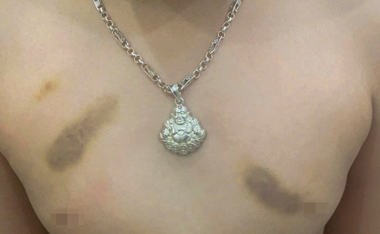 Hai vết bầm trên ngực cháu N.A.P. Ảnh: Người nhà cung cấp.