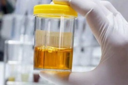 5 dấu hiệu cảnh báo axit uric cao và sỏi thận, phòng ngừa như thế nào?