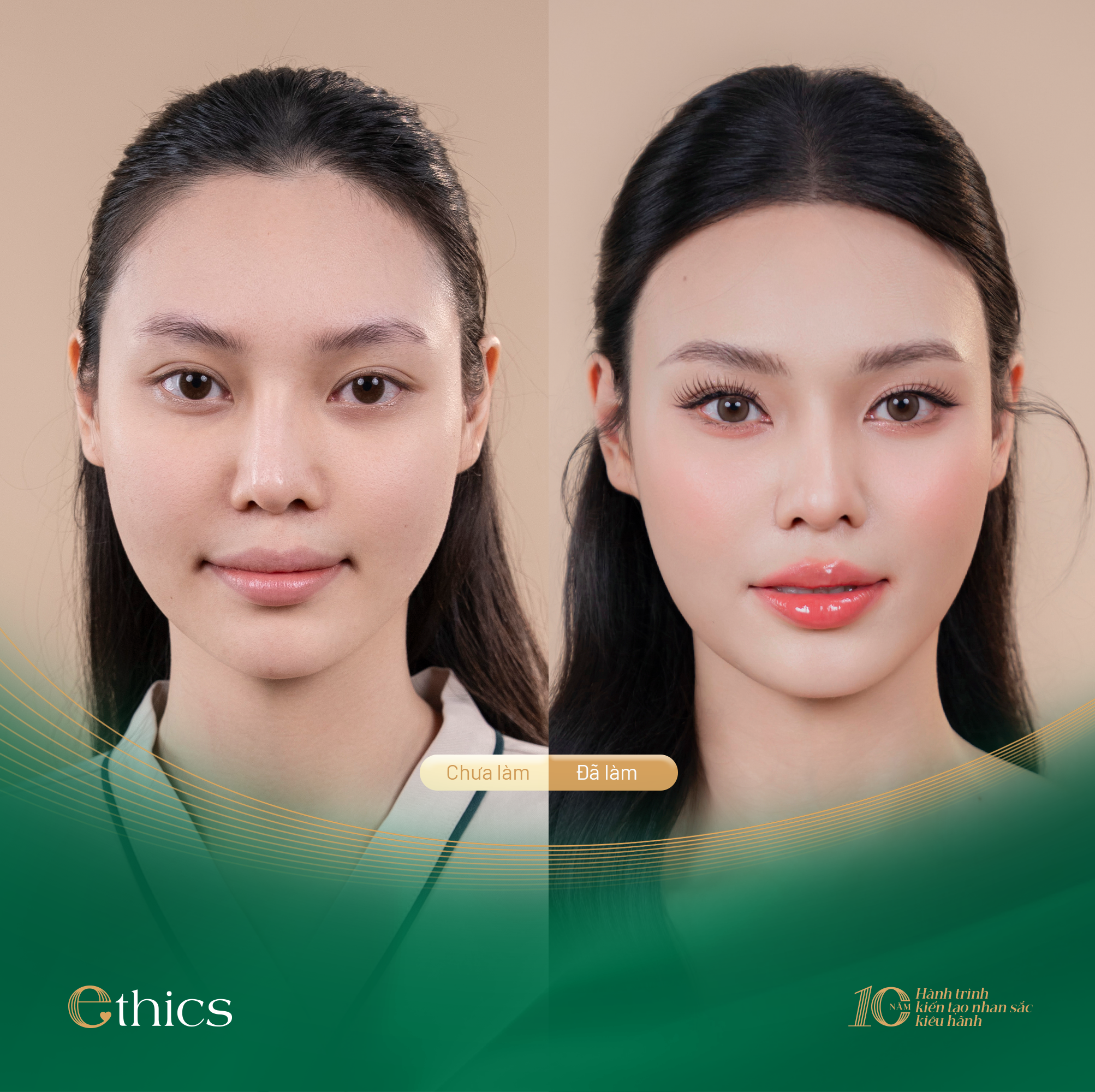 Ethics - Tiên phong ứng dụng độc quyền công nghệ nâng mũi FITme 3D - 3