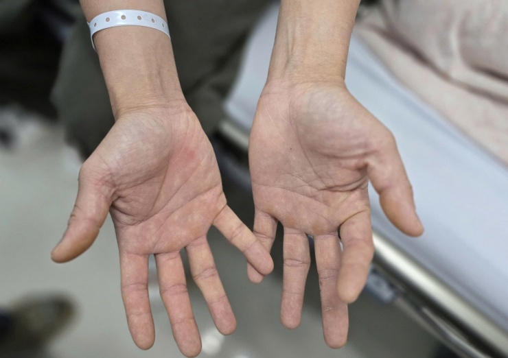 Bàn tay của anh H. bị tê bì, không thể khép lại và mất cảm giác