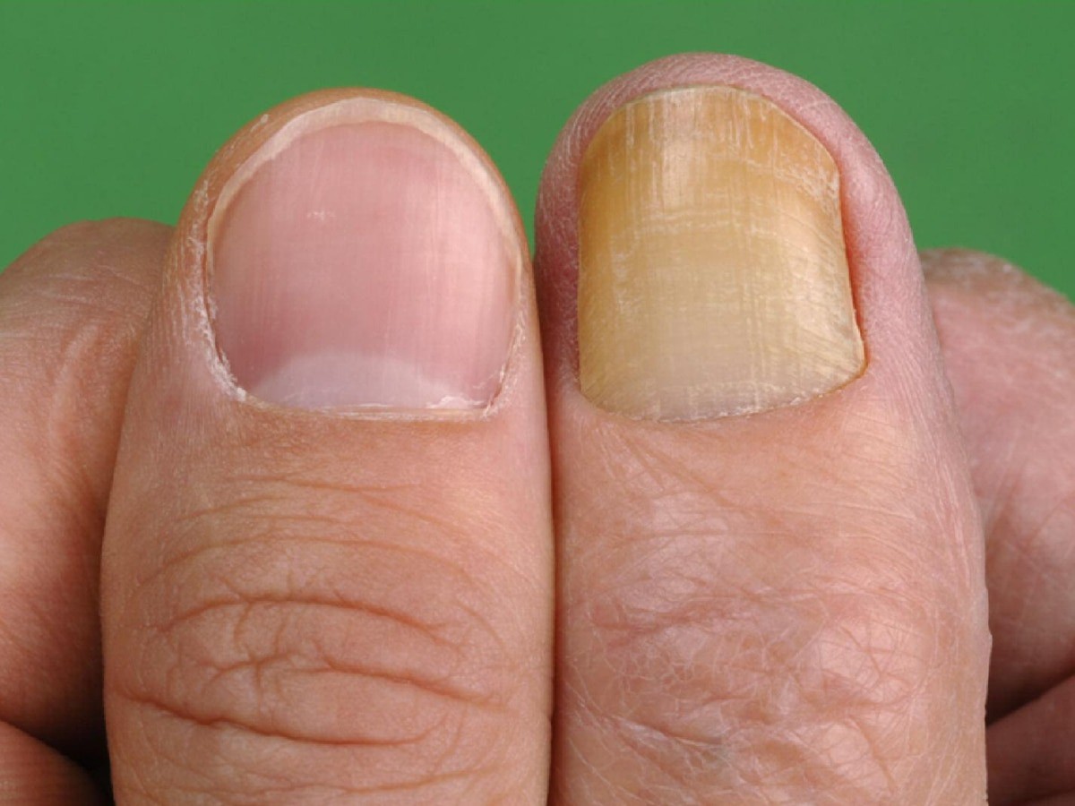 Móng tay chuyển sang màu vàng, coi chừng nguy cơ mắc bệnh nguy hiểm - 1