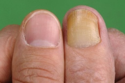 Móng tay chuyển sang màu vàng, coi chừng nguy cơ mắc bệnh nguy hiểm