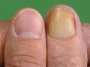 Móng tay chuyển sang màu vàng, coi chừng nguy cơ mắc bệnh nguy hiểm