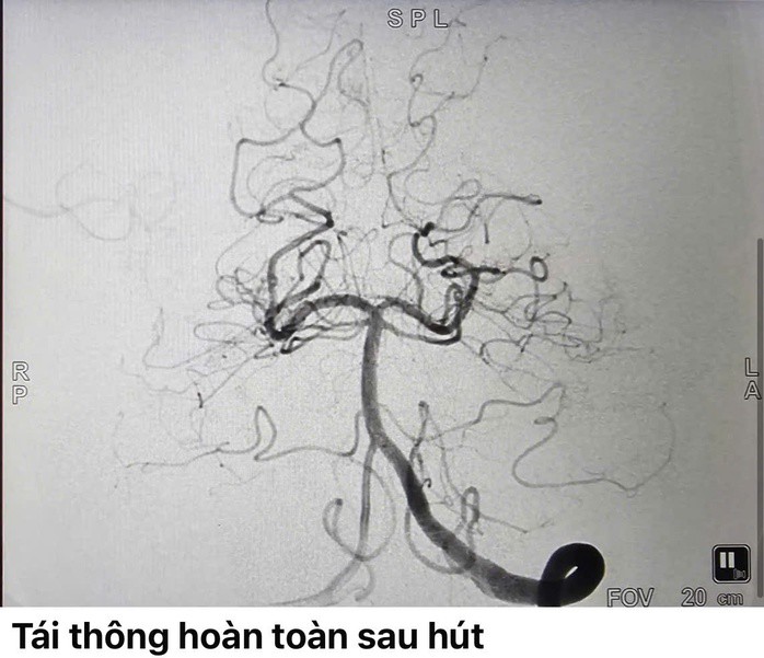 Bác sĩ hút thành công cục máu đông lớn, tái thông hoàn toàn dòng máu lên não