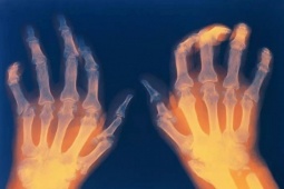 Tin tức sức khỏe - Giật mình: 6 thói quen khiến xương khớp phải “kêu cứu”