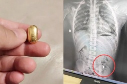 Cậu bé 11 tuổi nuốt nhầm hạt vàng trị giá 36 triệu đồng và cái kết