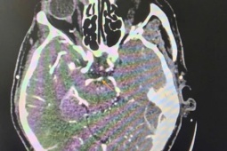 Đột quỵ khi uống bia, người đàn ông thoát chết ngoạn mục