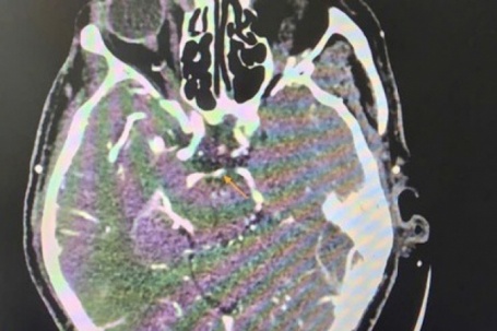 Đột quỵ khi uống bia, người đàn ông thoát chết ngoạn mục