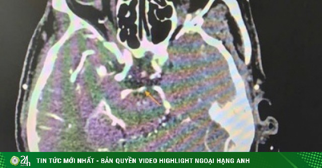Bệnh nhân đột quỵ, bác sĩ chăm sóc