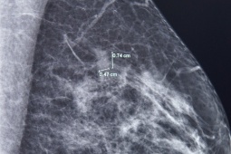 Bệnh nhân 61 tuổi chiến thắng ung thư vú nhờ phát hiện sớm