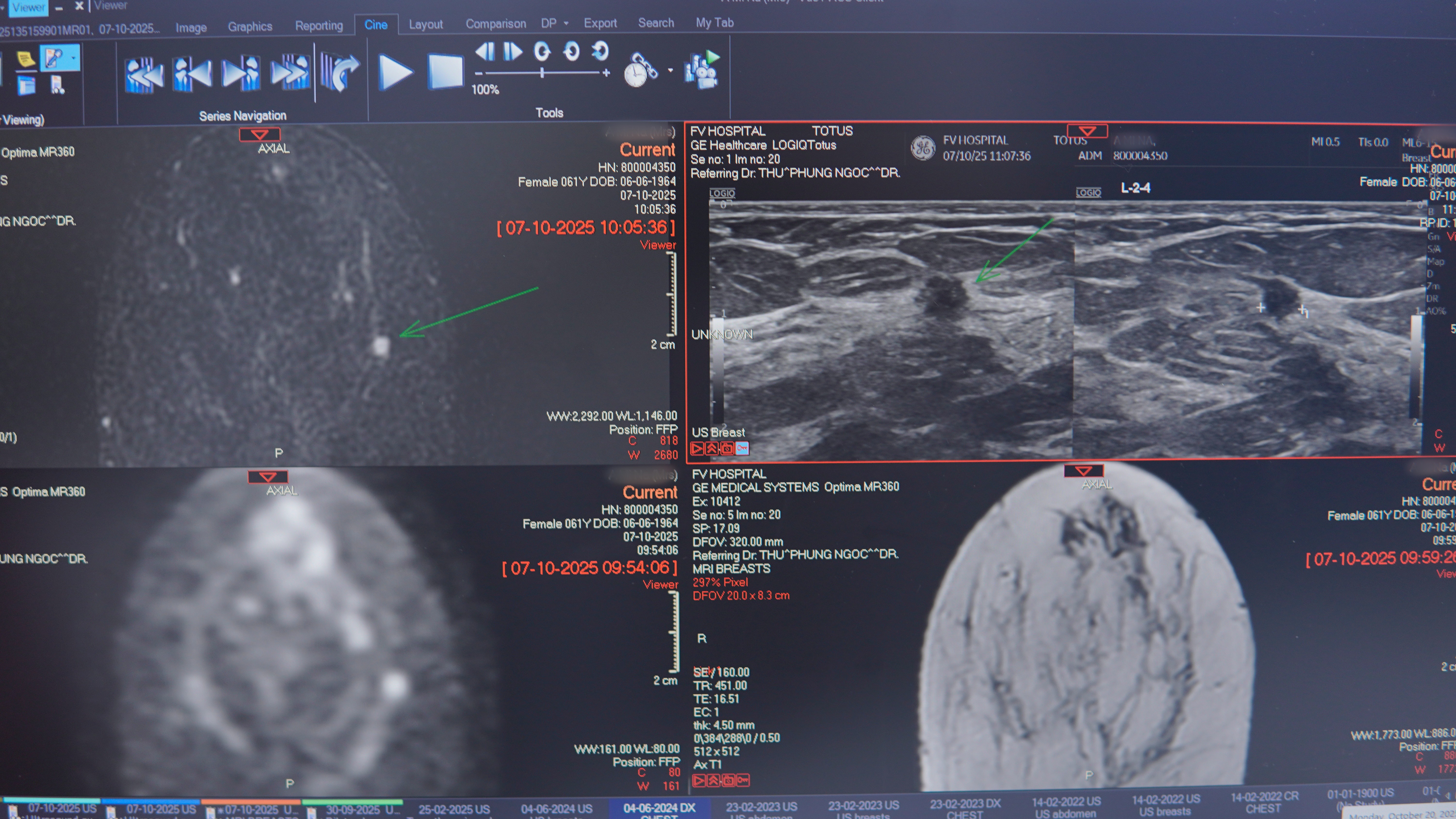 Hình chụp MRI cho thấy một tổn thương 3mm. Ảnh: FV
