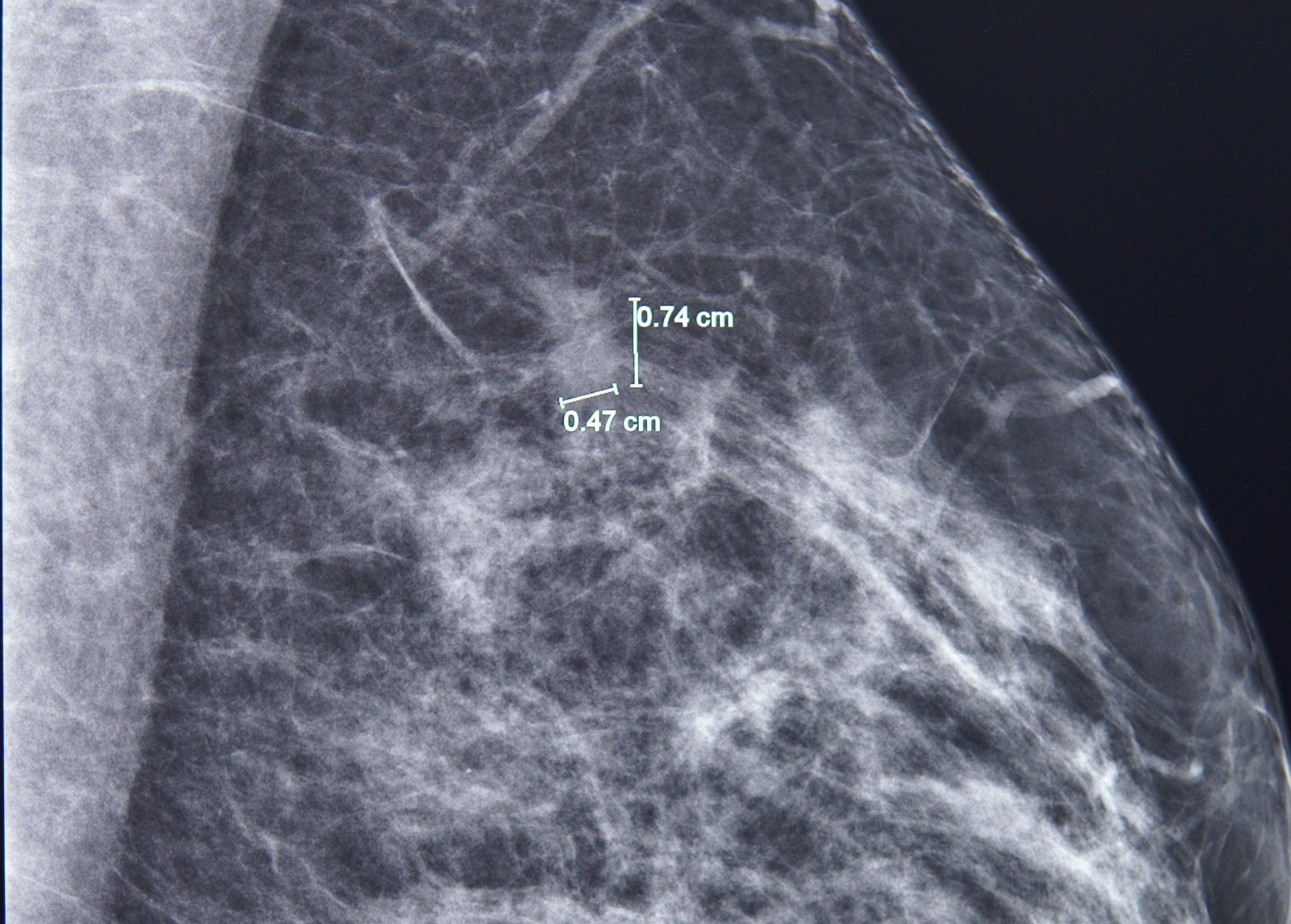 Phát hiện một tổn thương 7mm ở vú trái bằng chụp nhũ ảnh. Ảnh: FV