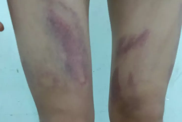 Bắt giam mẹ ruột và người tình vì ép bé gái 9 tuổi nhúng lưỡi vào nước sôi - 1